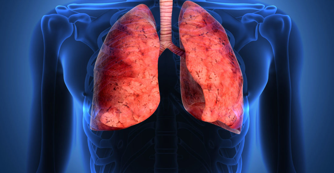 neumonía, pulmones