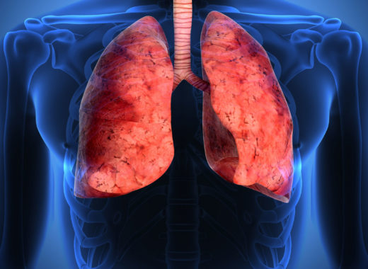 neumonía, pulmones